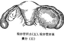 输卵管粘连